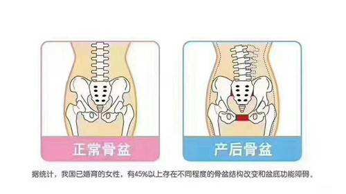 徒手骨盆閉合